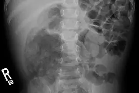 高中女生一夜排出8斤大便，医生告诉你其中的真相图片