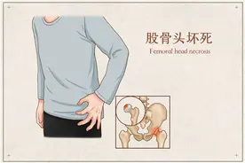 股骨头坏死并非“不死的癌症”，5点教你预防图片
