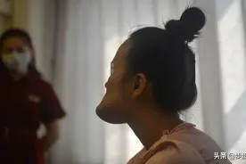 辽宁贫困女孩患怪病：下巴旋转生长，面部扭曲如“螺旋桨”图片
