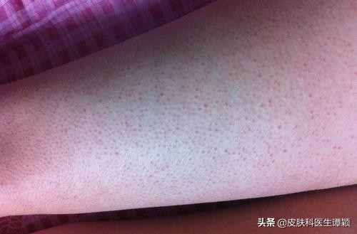 男朋友鸡皮肤太严重