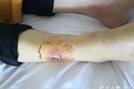 被蛇咬伤后，注射完血清就没事了？医生提醒：千万别这样做图片