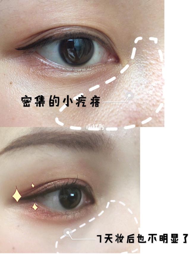毛周角化的痘痘怎么消除小妙招