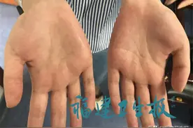 尴尬！福建女孩双手出汗近20年，连握手都害怕！这样根治，快转告身边的“水手”图片