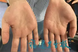 尴尬！福建女孩双手出汗近20年，连握手都害怕！这样根治，快转告身边的“水手”图片