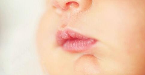 宝宝嘴上长泡怎么办