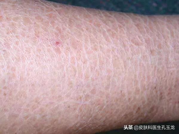 腿上有鱼鳞一样怎么回事 腿上有鱼鳞一样怎么回事
