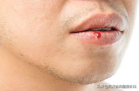 常见的唇部整形都有哪些？