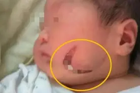 一岁娃脸上“产钳印”明显，宝妈怒找医院算账，却被说得哑口无言图片