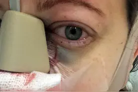 想减肥却管不住嘴迈不开腿，当下流行的抽脂减肥真的快速又安全吗图片