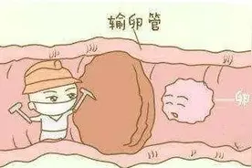 单侧输卵管堵塞会影响生育么？图片