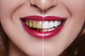 为什么明星的牙齿都这么白？医生：做了牙齿贴面图片