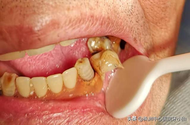 口腔粘膜角化是什么病