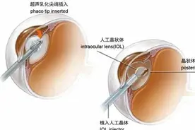 白内障如何治疗？专家来解答！图片