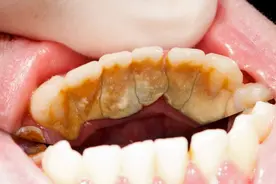 牙齿护理不当，牙垢积累，牙龈萎缩牙缝扩大！该如何解决？图片