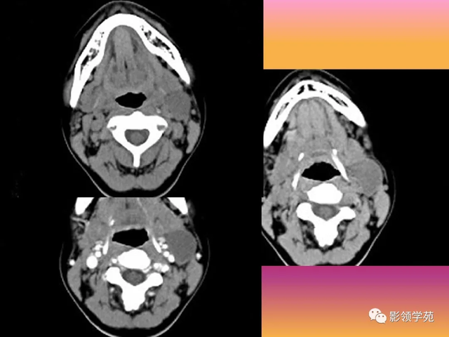 腮腺角化型鳞癌