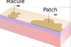 脓包痘痘挤还是不挤：这是一道送命题图片
