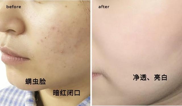 洗面奶中这2种网红护肤成分叠加使用：温和清洁+除螨杀菌＞2？