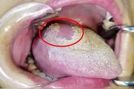 女子舌头肿痛半年被疑舌癌，没想到竟然是一根鱼刺作怪图片
