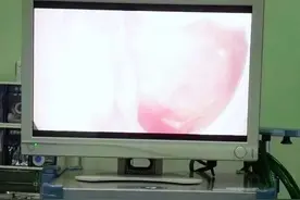 【患者福音】无痛微创胸腔镜检查术——为肺与胸膜疾病患者排忧解难图片