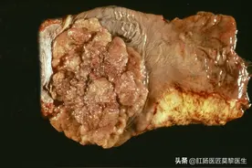 为什么有的肛管癌经过几次肠镜都没能查出来呢？图片