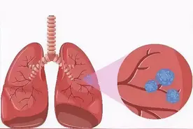 肺结节手术后影响生活吗图片