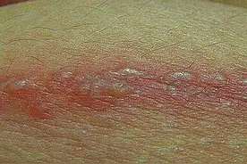 “蛇缠腰”长满一圈就会要人性命？有没有传染性？别轻信民间说法图片
