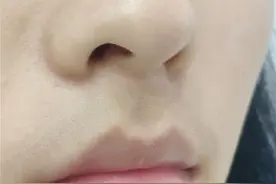 骆王宇你可真牛掰！去黑头绝了图片