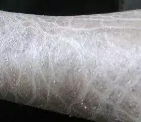 鱼鳞病流汗吗 鱼鳞病流汗吗