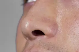 鼻毛长出鼻孔，能拔掉或者剪掉吗？鼻毛过长，到底是怎么回事？图片