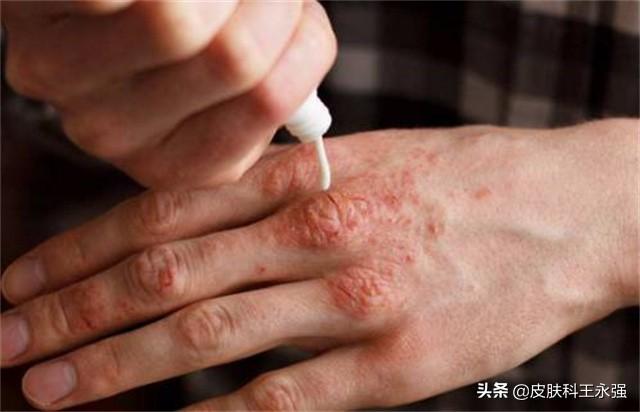 脚踝湿疹有水泡怎么办