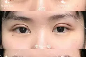 双眼皮手术后，会影响正常的工作生活吗？图片