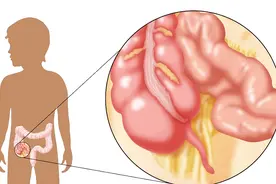 急性阑尾炎穿孔是怎么回事？视频封面