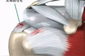 肩膀疼痛是怎么回事？本文告知您9种病因，让您再也不盲目咨询图片