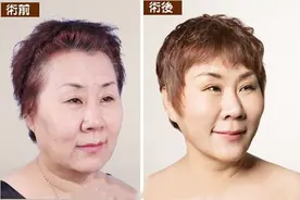 脸部提升做小切口拉皮手术的好处和坏处解析，利与弊一目了然图片