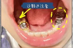 烧钱+懊悔！给娃套上4颗小钢牙后才醒悟......图片