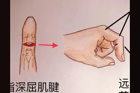 手被割伤了要紧吗：图解日常手部外伤图片