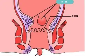 痔疮不痛不痒，是不是就没事了？图片