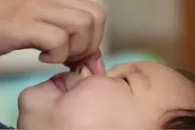 为了增高捏鼻梁，当心造成鼻损伤图片