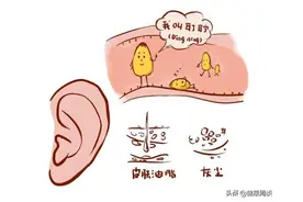 耳屎究竟是咋形成的？为啥有的人耳屎干干的有人油油的？图片