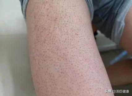 结婚时手臂鸡皮肤