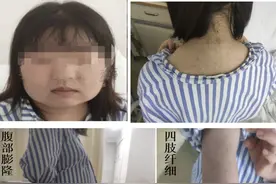 16岁姑娘长出一圈“小胡子”，原来是她的“脑子”出了问题图片