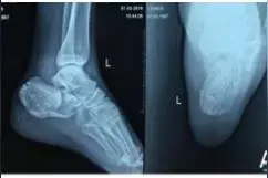 撬拨复位微创置板与经“L”型切口内固定治疗跟骨骨折的比较图片