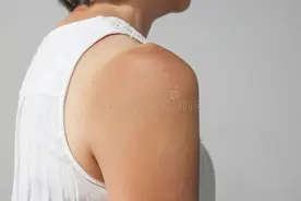 皮肤晒红、晒痛怎么办？教你几招“抢救”晒伤皮肤图片