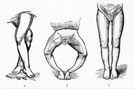 儿童维生素D缺乏会导致佝偻病你知道么？维生素D是通过吃来补充么图片