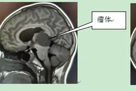 9岁男孩松果体长肿瘤 江西省儿童医院为其进行微创手术图片
