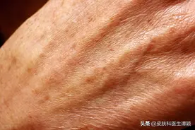 皮肤科医生和你聊聊：老年斑/脂溢性角化可以如何治疗？图片