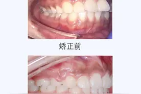 李赛妮医生矫正案例——牙列拥挤图片