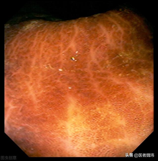 你的肠道怎么变黑了？