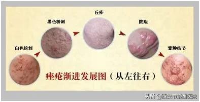 毛囊皮脂腺导管角化是什么意识