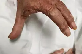 一次意外手指刮伤，82岁老伯几天后吞咽困难、呼吸困难，医生为他紧急截肢保命！只因一种细菌感染图片